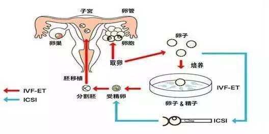 沈阳试管婴儿攻略